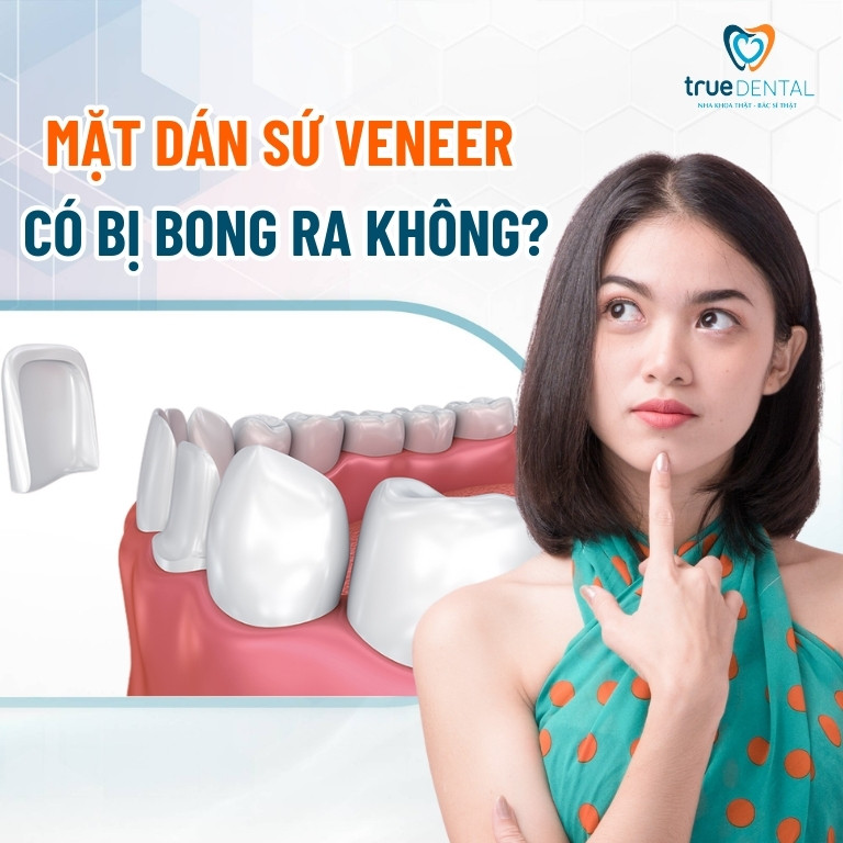 MẶT DÁN SỨ VENEER CÓ BỊ BONG RA KHÔNG? CÁCH XỬ LÝ LÀ GÌ? 1 Mặt dán sứ veneer có bị bong ra không?
