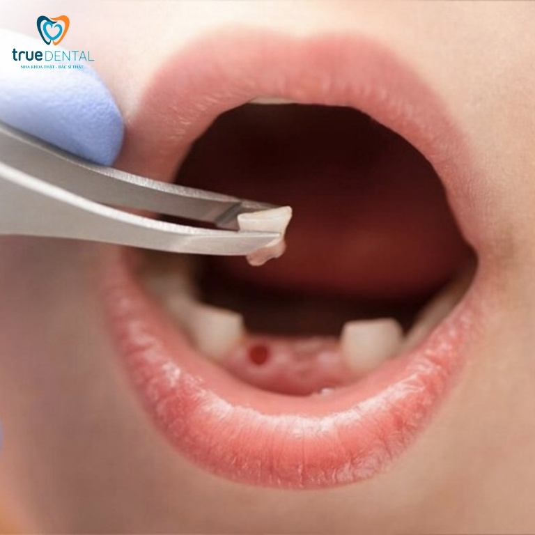 NHỔ RĂNG SỮA CHO TRẺ EM: LỢI ÍCH VÀ NHỮNG ĐIỀU CẦN LƯU Ý 5 Quy trình nhổ răng sữa cho bé