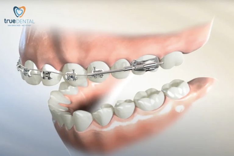 Niềng răng 1 hàm mất bao lâu, giá bao nhiêu tiền? 1 Niềng răng 1 hàm là gì?