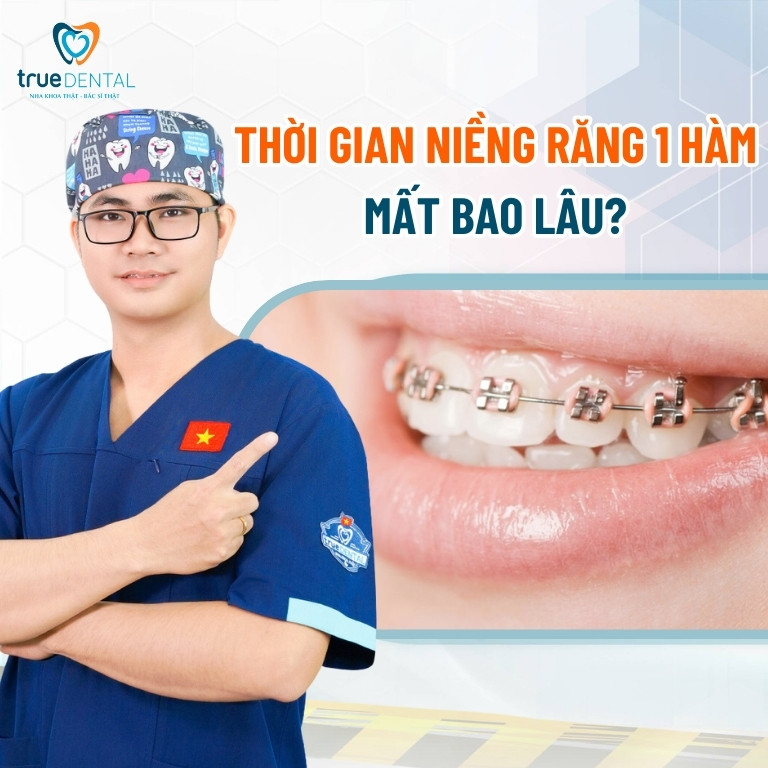 Niềng răng 1 hàm mất bao lâu, giá bao nhiêu tiền? 3 Thời gian niềng răng 1 hàm mất bao lâu?