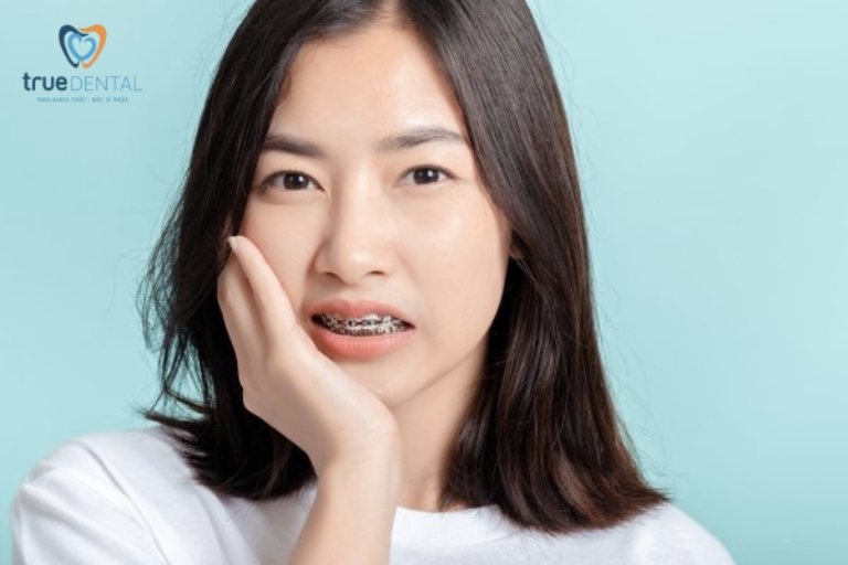 NIỀNG RĂNG BỊ MỎI HÀM: LÝ DO VÀ CÁCH KHẮC PHỤC 1 Hiện tượng mỏi hàm khi niềng răng