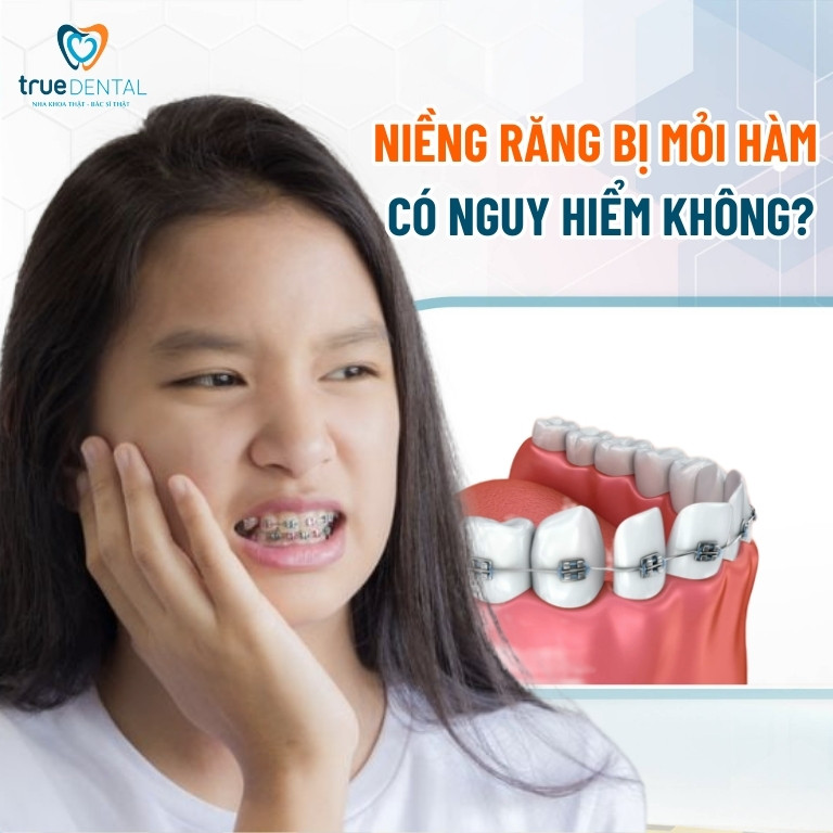 NIỀNG RĂNG BỊ MỎI HÀM: LÝ DO VÀ CÁCH KHẮC PHỤC 2 Niềng răng bị mỏi hàm có nguy hiểm không?