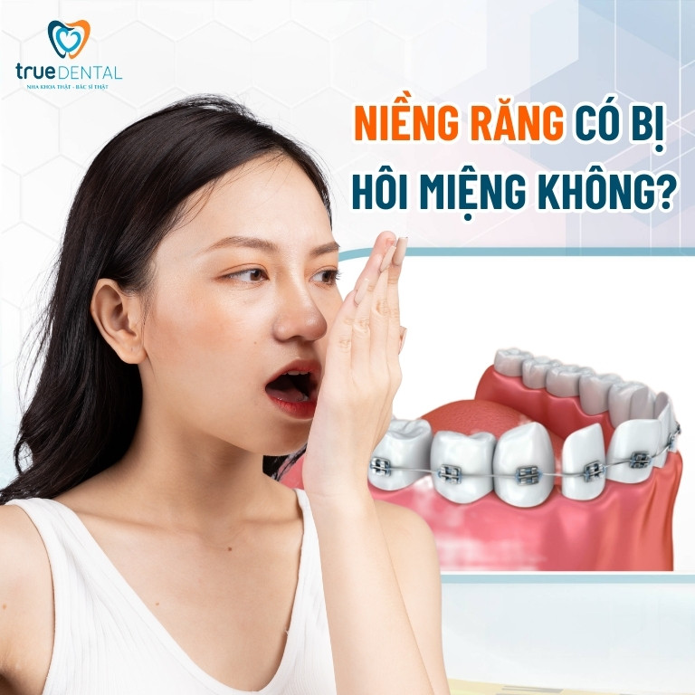 NIỀNG RĂNG CÓ BỊ HÔI MIỆNG KHÔNG? LÀM SAO ĐỂ ĐIỀU TRỊ? 1 Niềng răng có bị hôi miệng không?