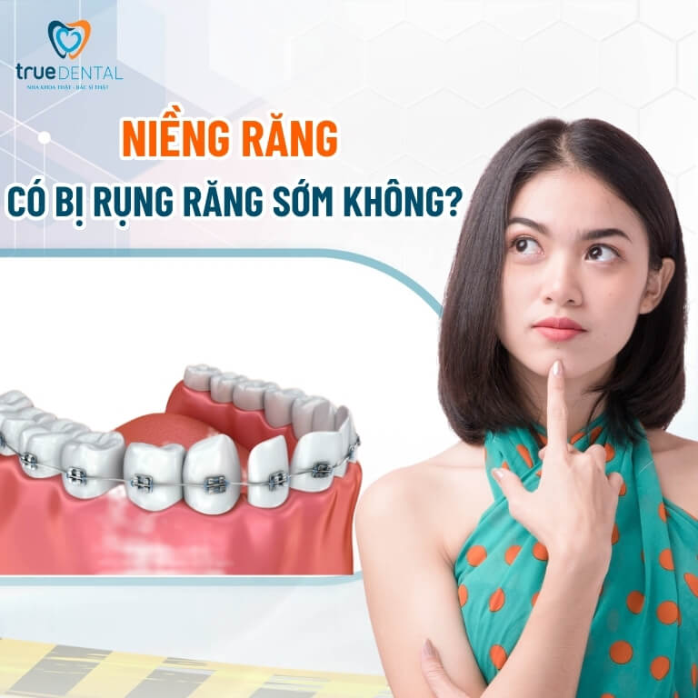 Niềng răng có bị rụng răng sớm không? 2 Niềng răng có bị rụng răng sớm không?