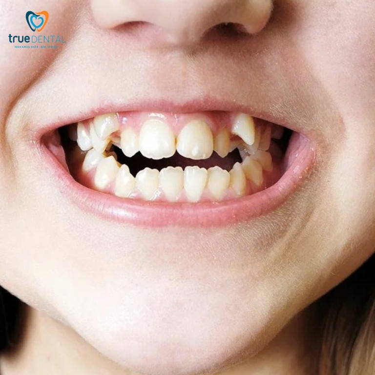 CÓ NÊN NIỀNG RĂNG LÒI XỈ KHÔNG? GIÁ RA SAO? NIỀNG TRONG BAO LÂU? 1 Răng lòi xỉ là gì?