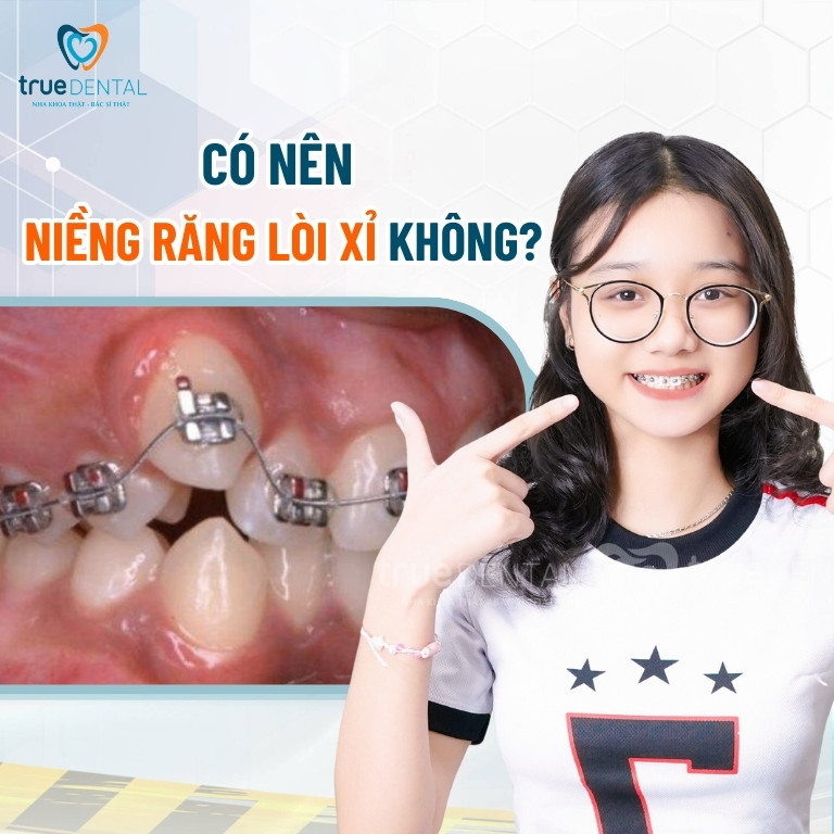 CÓ NÊN NIỀNG RĂNG LÒI XỈ KHÔNG? GIÁ RA SAO? NIỀNG TRONG BAO LÂU? 3 Có nên niềng răng lòi xỉ không?
