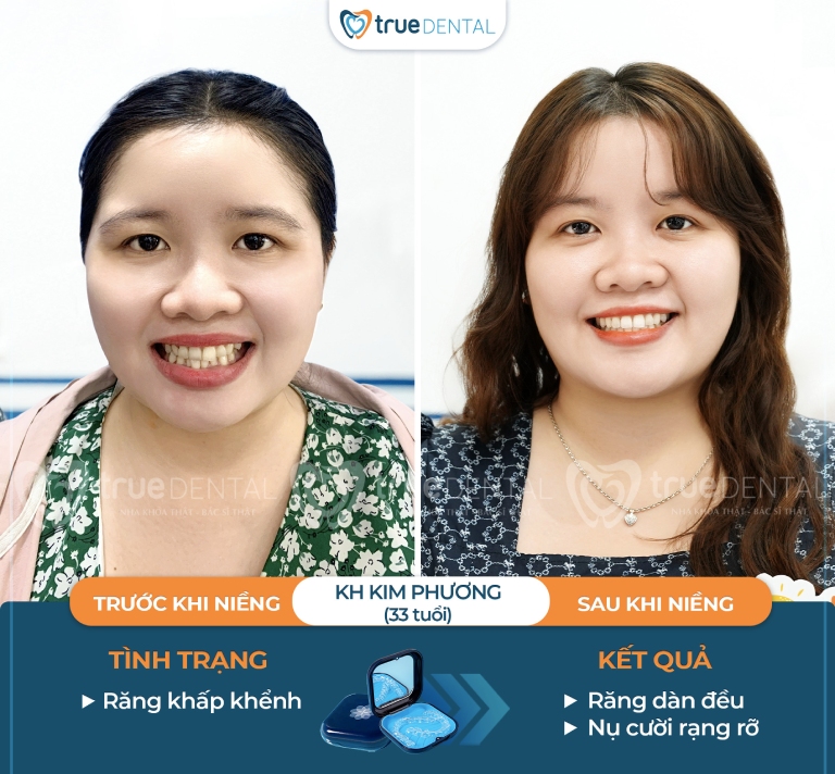 Quy trình niềng răng có mấy bước? Các giai đoạn niềng 4 Quy trình niềng răng trong suốt
