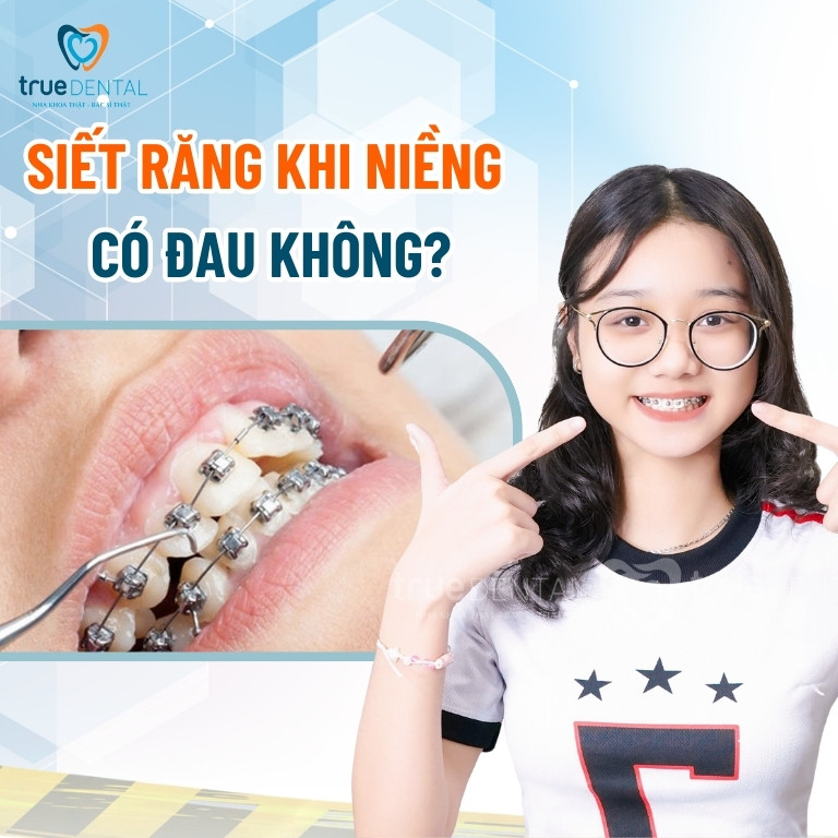 SIẾT RĂNG KHI NIỀNG LÀ GÌ? DIỄN RA NHƯ THẾ NÀO? CÓ ĐAU KHÔNG? 3 Siết răng khi niềng có đau không?