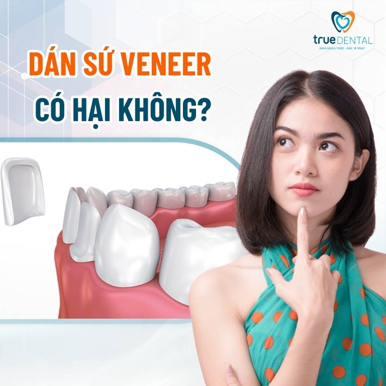 Dán sứ veneer có hại không?