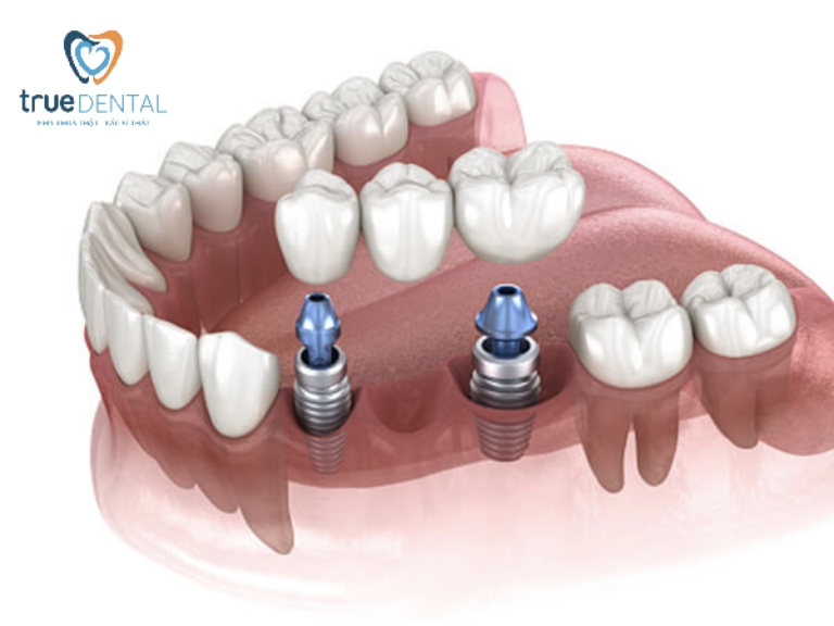 Trồng răng Implant là gì? Những điều cần biết, giá bao nhiêu 4 Cầu răng sứ trên Implant