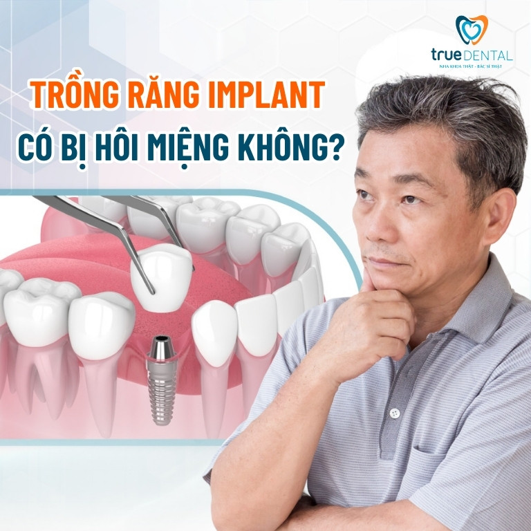 Trồng răng Implant có bị hôi miệng không?
