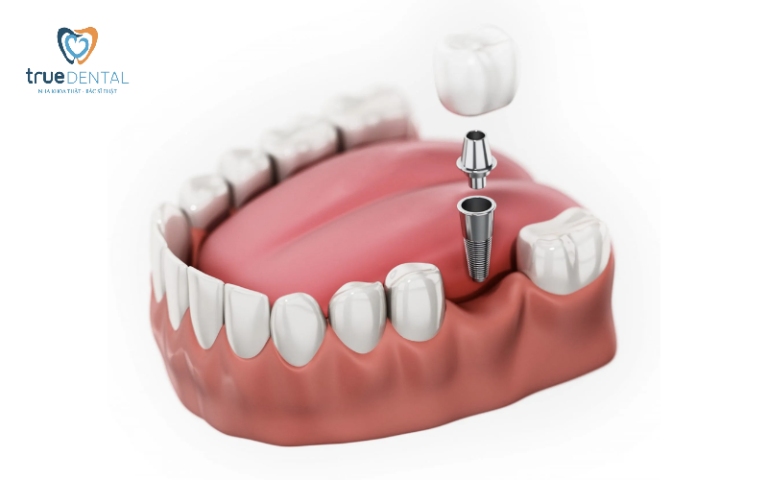 Cấy Ghép Implant Có Tốt Không? Sự Thật Không Phải Ai Cũng Biết 1 cấy ghép Implant