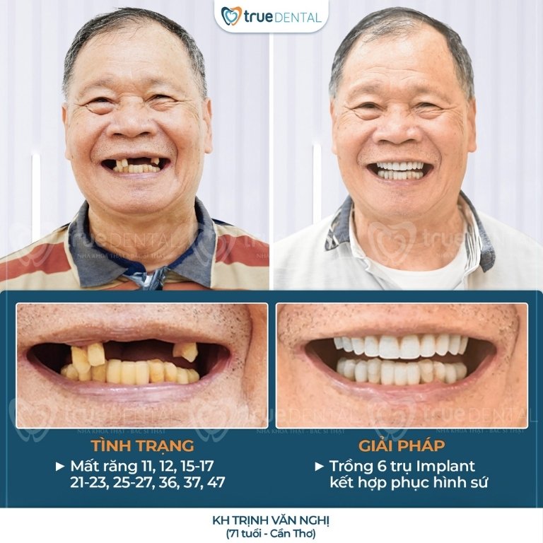 Trồng răng Implant là gì? Những điều cần biết, giá bao nhiêu 9 Hình ảnh trồng răng Implant