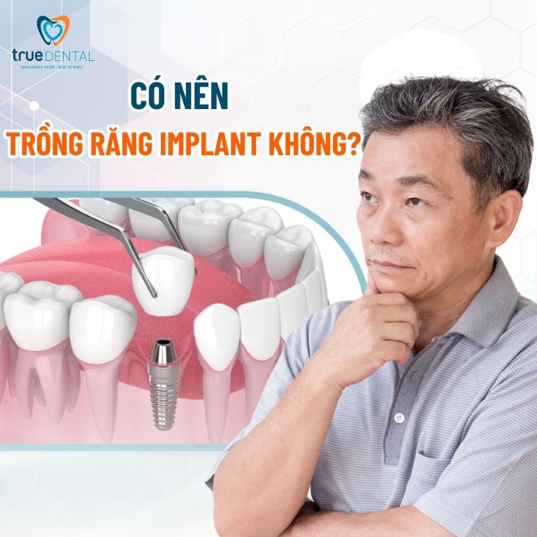 Trồng răng Implant là gì? Những điều cần biết, giá bao nhiêu 7 Có nên trồng răng Implant không?