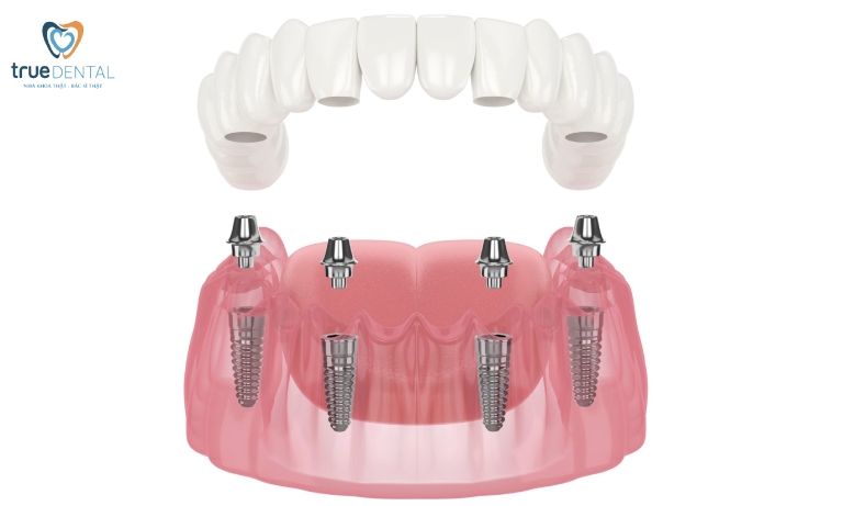 Trồng răng Implant là gì? Những điều cần biết, giá bao nhiêu 5 Cấy ghép Implant toàn hàm