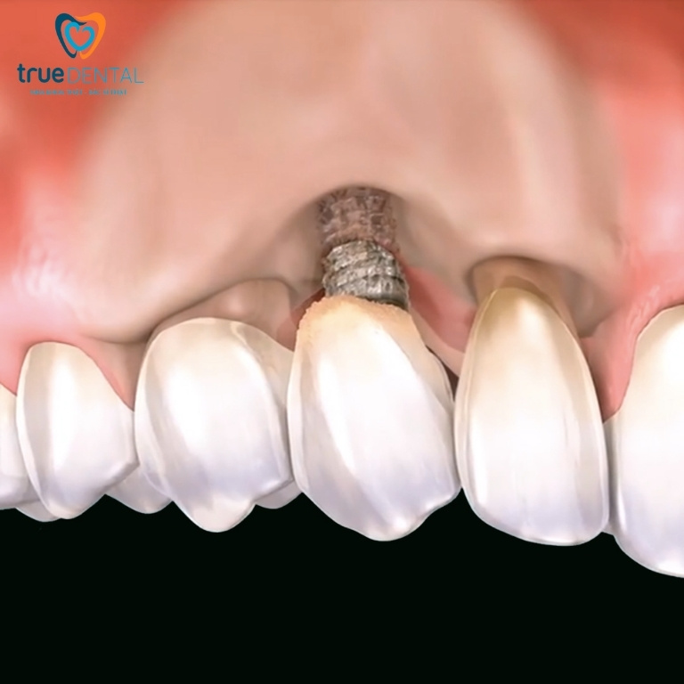 Implant bị đào thải: Dấu hiệu, nguyên nhân và cách khắc phục 1 Trụ Implant bị đào thải là gì?