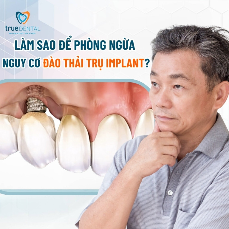 Implant bị đào thải: Dấu hiệu, nguyên nhân và cách khắc phục 5 Làm sao để phòng ngừa nguy cơ đào thải trụ Implant?