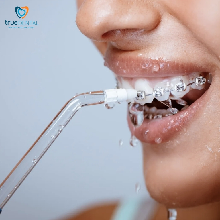 HƯỚNG DẪN VỆ SINH RĂNG KHI ĐEO NIỀNG BẠN CẦN BIẾT 5 Hướng dẫn chi tiết cách vệ sinh răng miệng khi đeo niềng