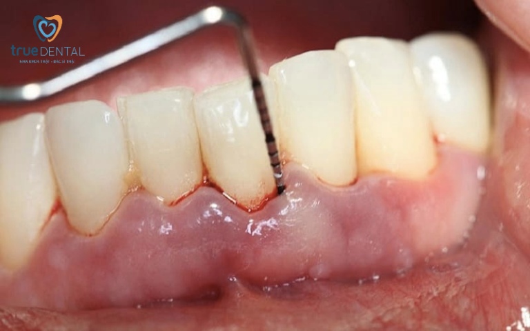 Viêm chân răng là gì? Nguyên nhân và cách điều trị, phòng ngừa 5 Viêm chân răng có nguy hiểm không
