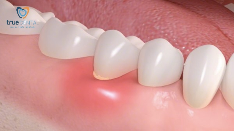 Viêm chân răng là gì? Nguyên nhân và cách điều trị, phòng ngừa 2 Nguyên nhân gây viêm chân răng