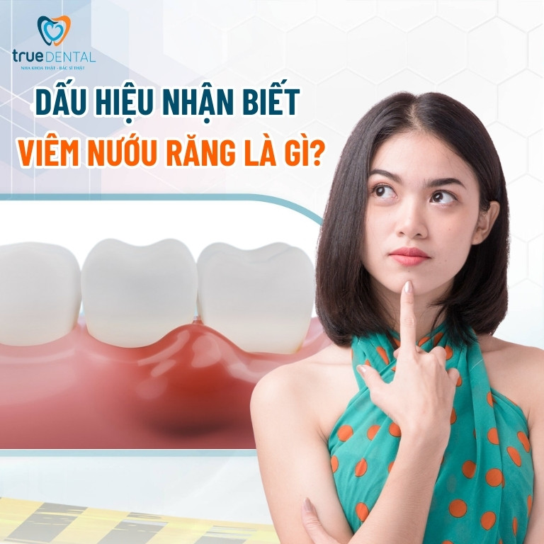 VIÊM NƯỚU RĂNG: NGUYÊN NHÂN, CÁCH NHẬN BIẾT VÀ CHỮA TRỊ HIỆU QUẢ 3 Dấu hiệu nhận biết viêm nướu răng là gì?