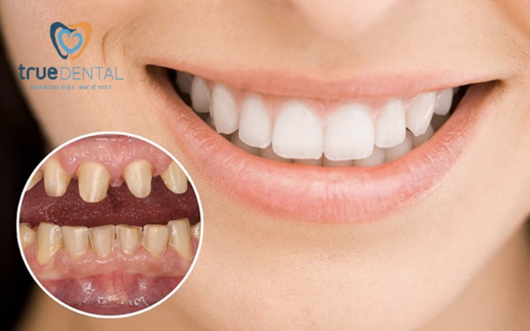 Bọc răng sứ cho răng thưa bao nhiêu tiền? Có nên không 2 Ưu, nhược điểm khi bọc sứ cho răng thưa