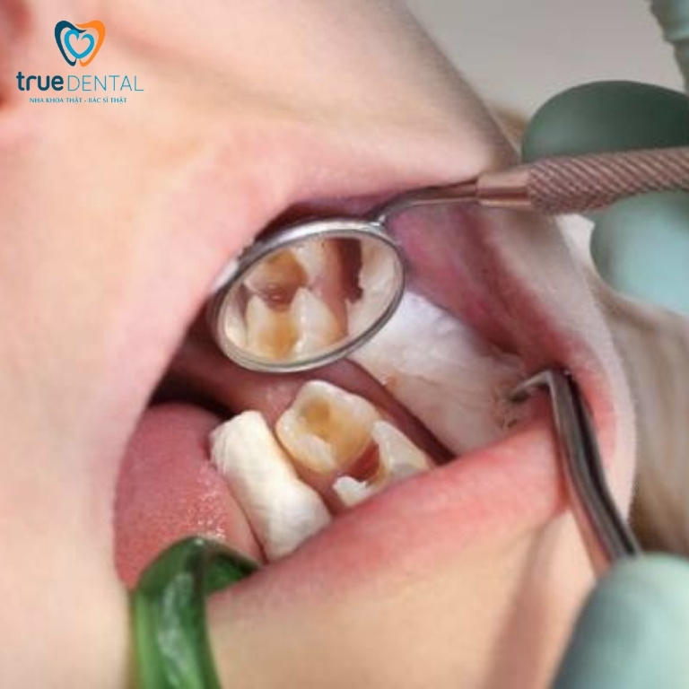 Cách điều trị viêm tủy răng ở trẻ em và cách phòng ngừa 6 Lấy tuỷ răng
