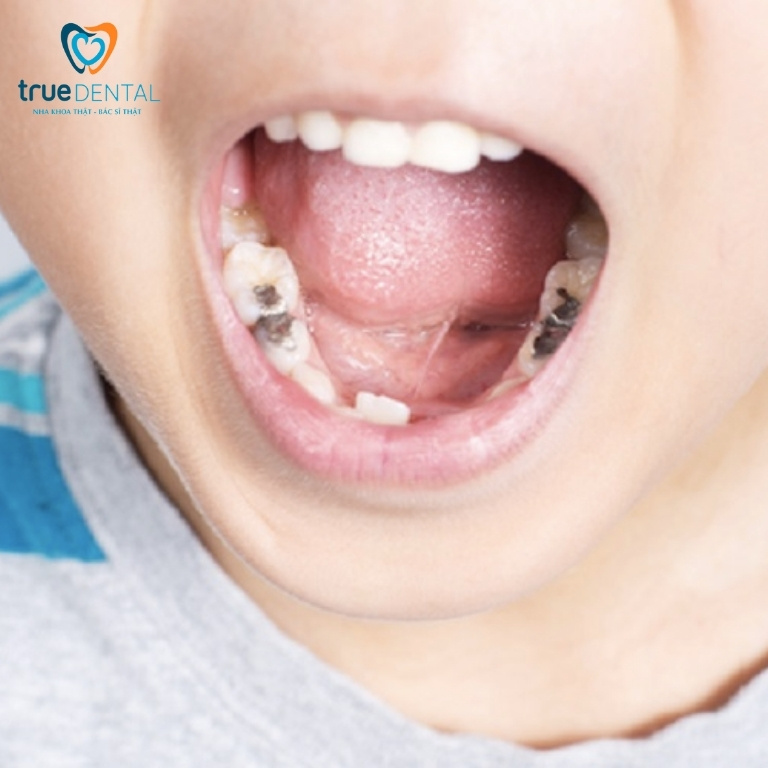 Cách điều trị viêm tủy răng ở trẻ em và cách phòng ngừa 2 Dấu hiệu viêm tuỷ răng ở trẻ