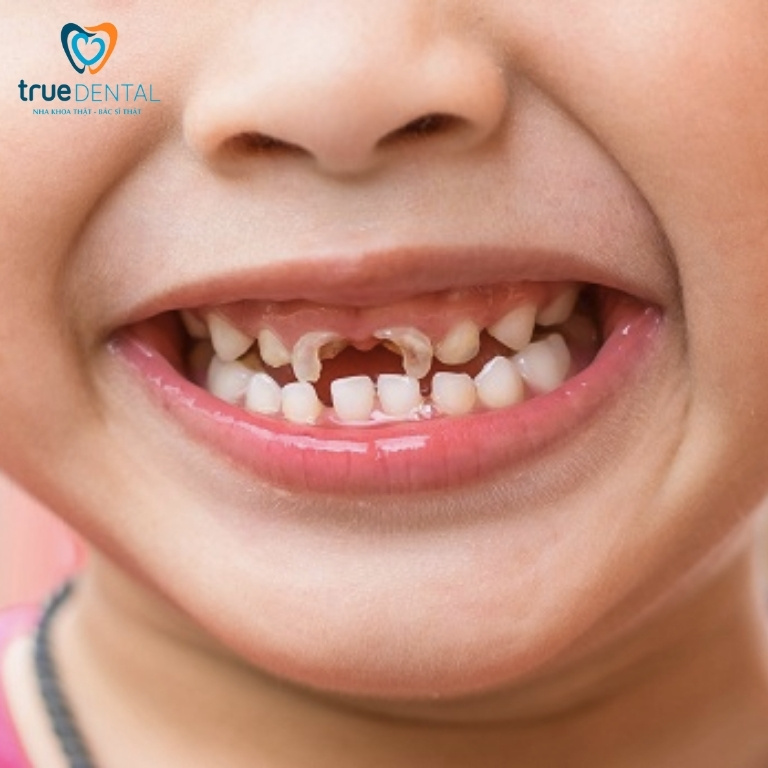 Cách điều trị viêm tủy răng ở trẻ em và cách phòng ngừa 4 Chấn thương răng gây viêm tuỷ răng sữa