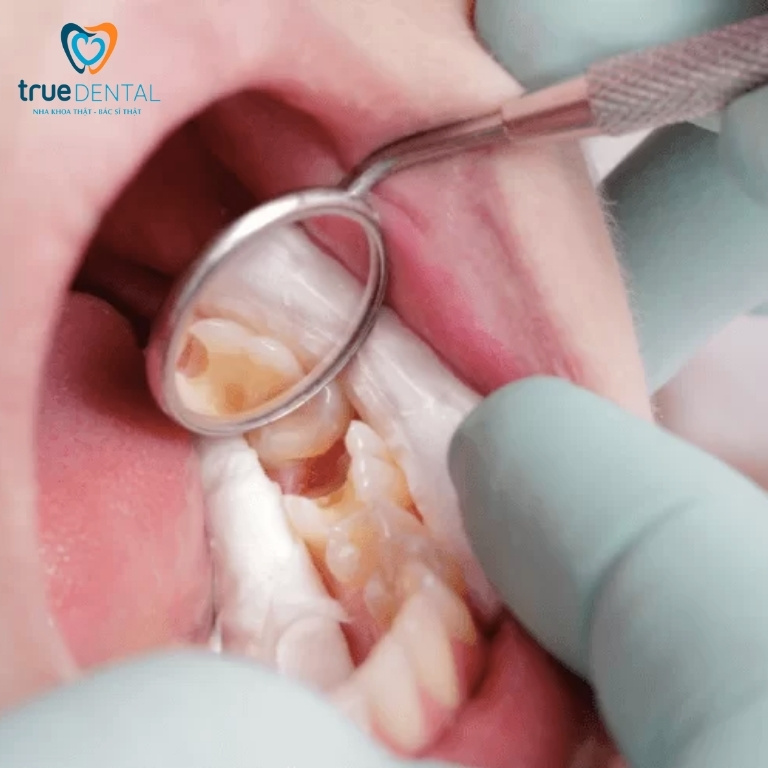 Cách điều trị viêm tủy răng ở trẻ em và cách phòng ngừa 5 Khi nào nên lấy tuỷ răng cho trẻ?