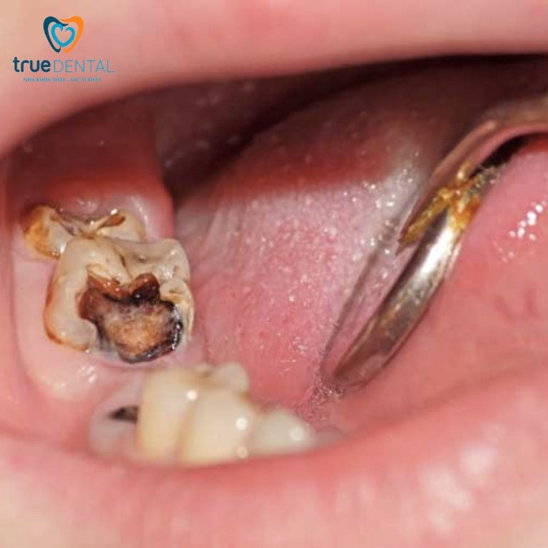Cách điều trị viêm tủy răng ở trẻ em và cách phòng ngừa 3 Nguyên nhân gây viêm tuỷ răng sữa ở trẻ
