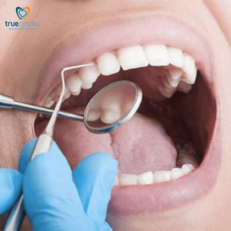 Cạo vôi răng ở đâu tốt và uy tín tại TP HCM 1 Những điều cần biết về địa chỉ cạo vôi răng uy tín TPHCM