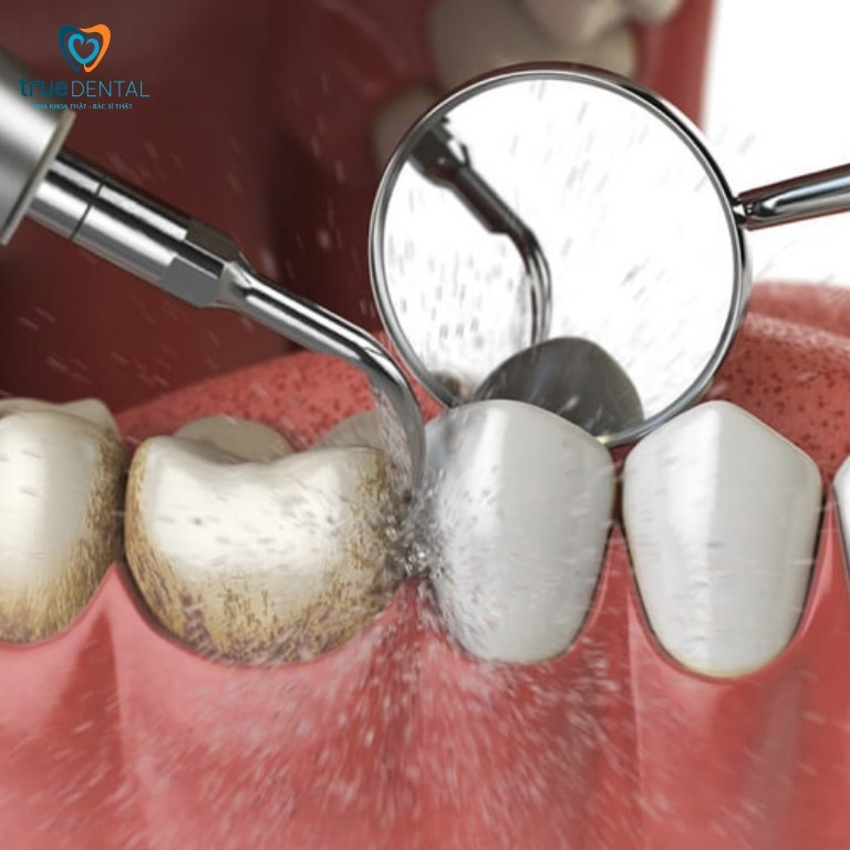 Răng có vết đen: Nguyên nhân, cách chữa trị và phòng ngừa 11 Lấy cao răng