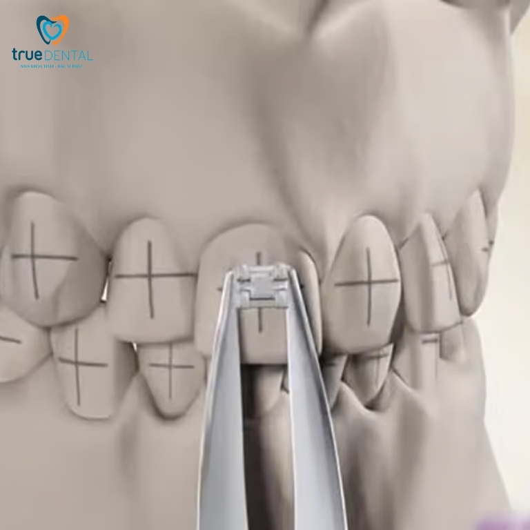 Gắn mắc cài: Vị trí, quy trình gắn chuẩn nhất 5 Cách gắn từng mắc cài chỉnh nha