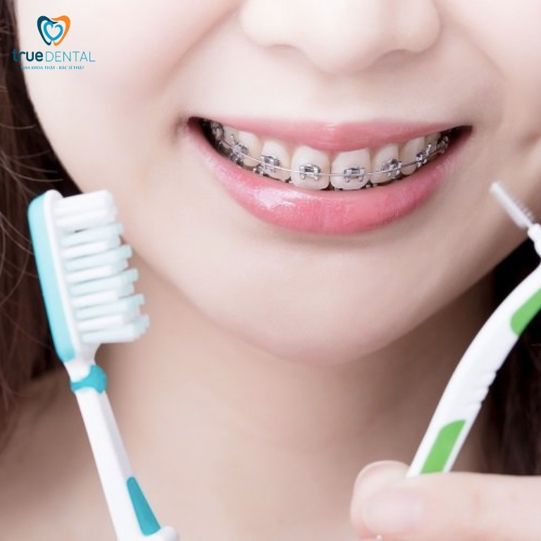 Gắn mắc cài: Vị trí, quy trình gắn chuẩn nhất 8 Lưu ý nên vệ sinh răng kỹ lưỡng sau khi gắn mắc cài niềng răng