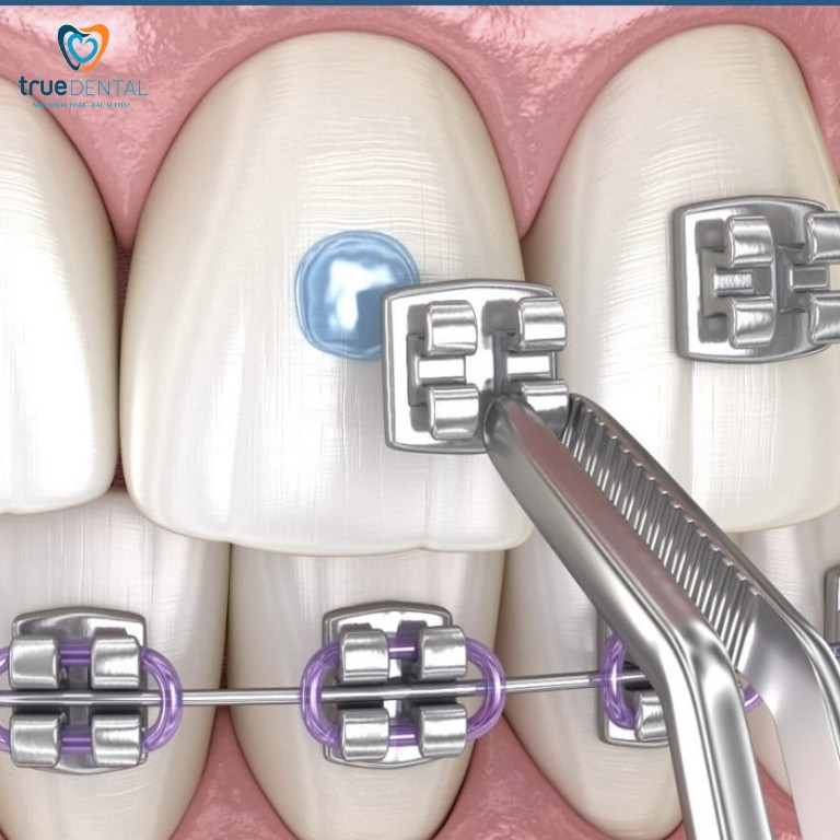 Niềng răng sắt là gì? Thời gian, chi phí, ưu và nhược điểm 1 Niềng răng sắt có những loại nào?
