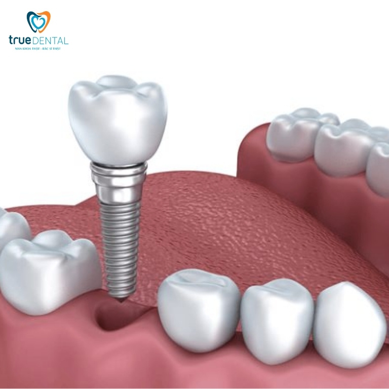 Implant nha khoa là gì? khi nào cần cấy ghép implant 1 Implant nha khoa là gì?