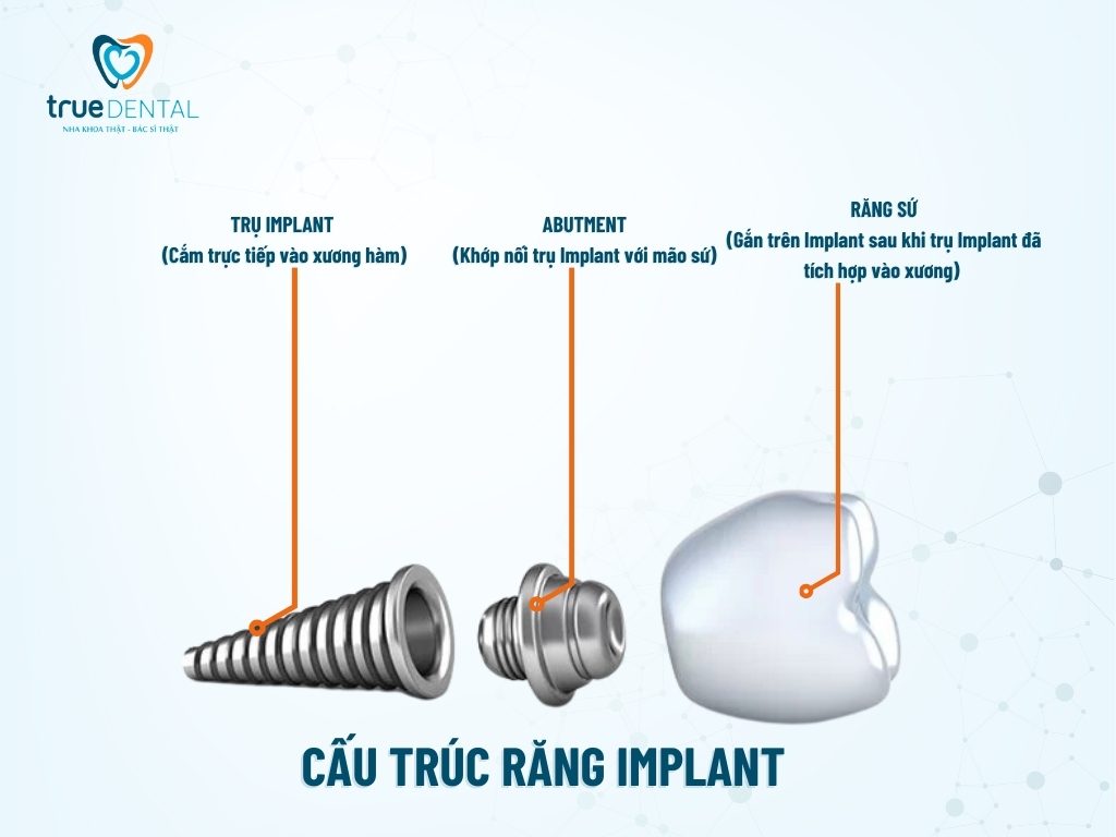 Implant nha khoa là gì? khi nào cần cấy ghép implant 3 Cấu trúc răng Implant
