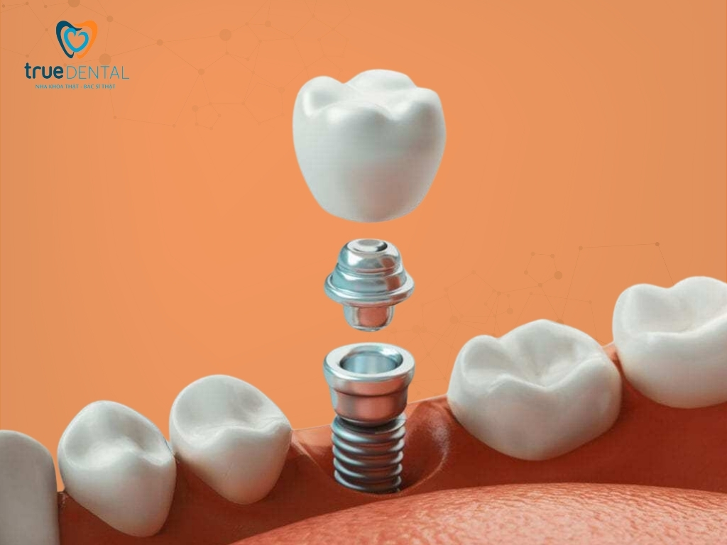 Implant nha khoa là gì? khi nào cần cấy ghép implant 4 Trường hợp nào nên trồng Implant nha khoa?
