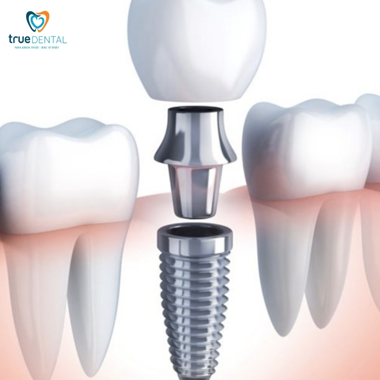 Implant nha khoa là gì? khi nào cần cấy ghép implant 2 Ưu và nhược điểm của Implant nha khoa