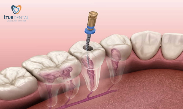 Lấy tủy răng có đau không? Lưu ý và quy trình lấy tủy răng 3 Nguyên nhân trị tuỷ xong bị đau