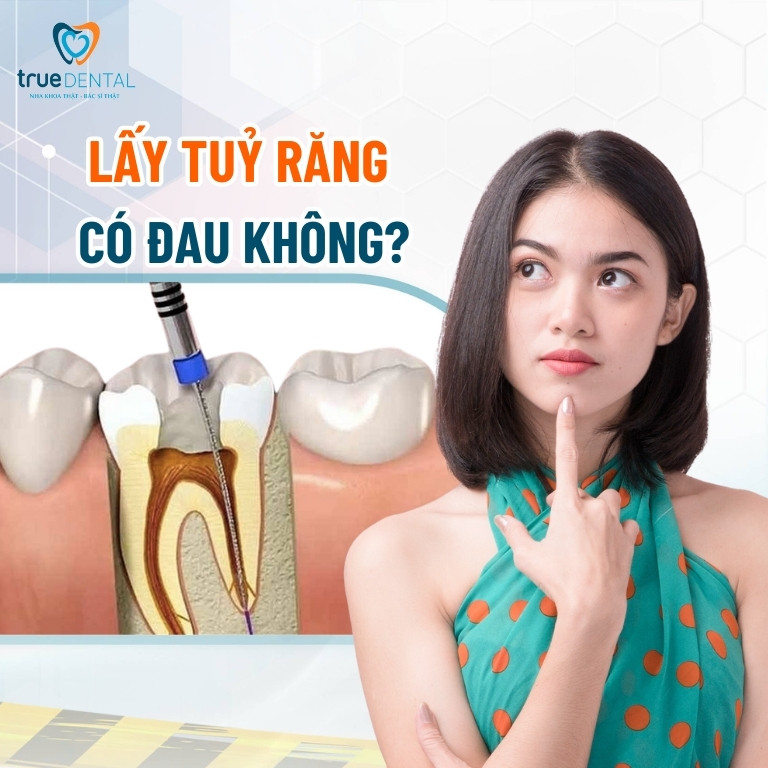 Lấy tủy răng có đau không? Lưu ý và quy trình lấy tủy răng 2 lấy tuỷ răng có đau không?