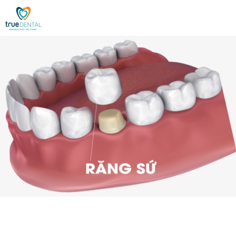 Lấy tủy răng là gì? Tại sao phải lấy tủy răng? 9 Bọc răng sứ để bảo vệ răng đã lấy tuỷ