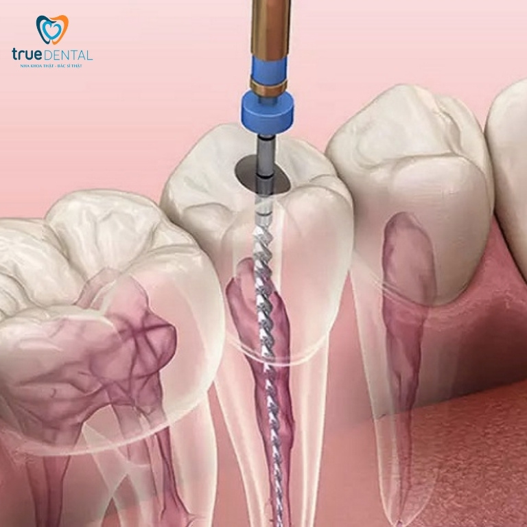 Lấy tủy răng là gì? Tại sao phải lấy tủy răng? 1 Lấy tuỷ răng là gì?