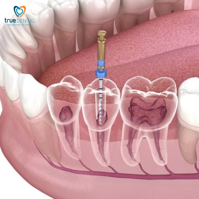 Lấy tủy răng là gì? Tại sao phải lấy tủy răng? 2 Tạo sao phải lấy tuỷ răng?