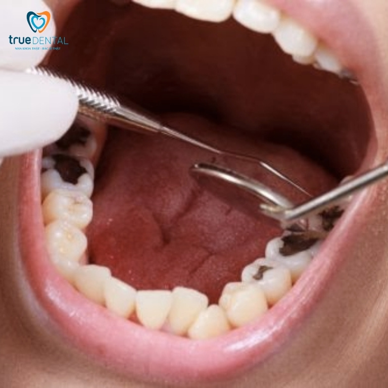Lấy tủy răng là gì? Tại sao phải lấy tủy răng? 3 Khi nào cần lấy tuỷ răng?