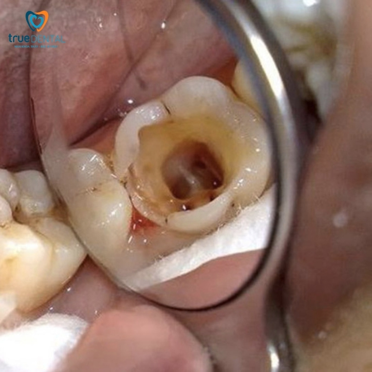 Lấy tủy răng là gì? Tại sao phải lấy tủy răng? 4 Lấy tuỷ răng có hại gì không?