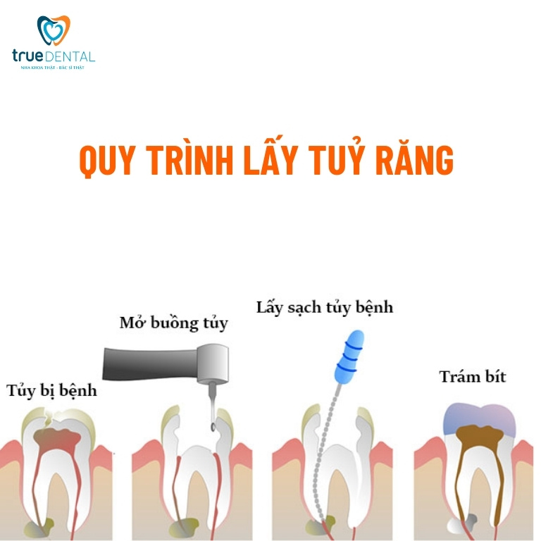 Lấy tủy răng là gì? Tại sao phải lấy tủy răng? 6 Gây tê, lấy tuỷ