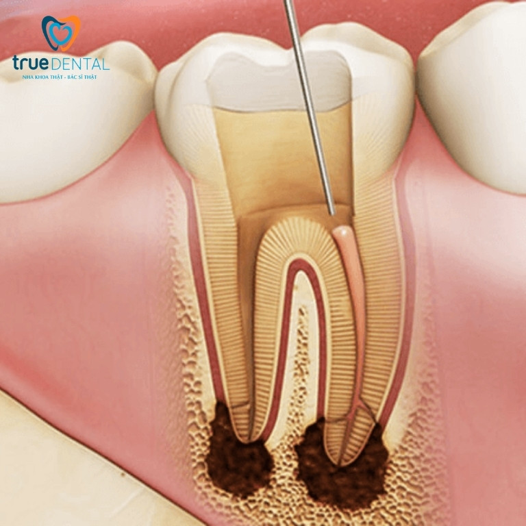 Lấy tủy răng có đau không? Lưu ý và quy trình lấy tủy răng 1 Lấy tủy răng là gì?