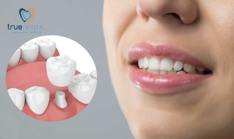 Răng lấy tủy có nên bọc răng sứ lại không? 4 Bọc sứ sau lấy tủy có đau không?